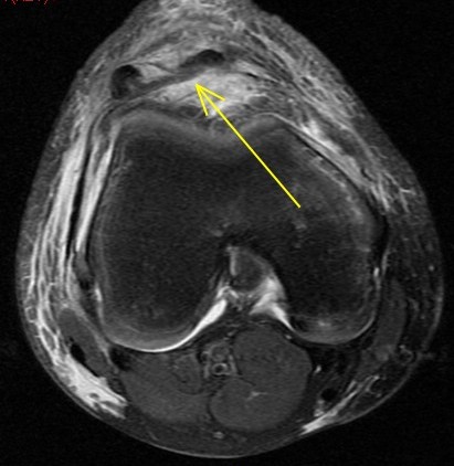 Figure 5 for case Patellar sleeve avulsion